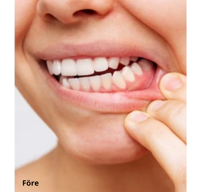 Dentaclean™ Pro 2.0