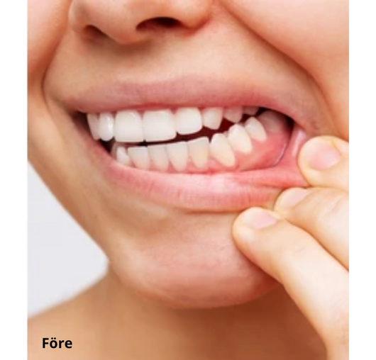 Dentaclean™ Pro 2.0