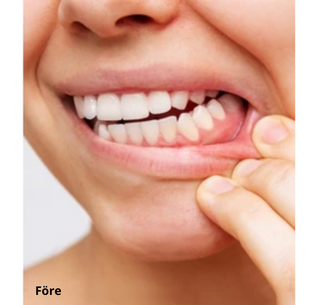 Dentaclean™ Pro 2.0